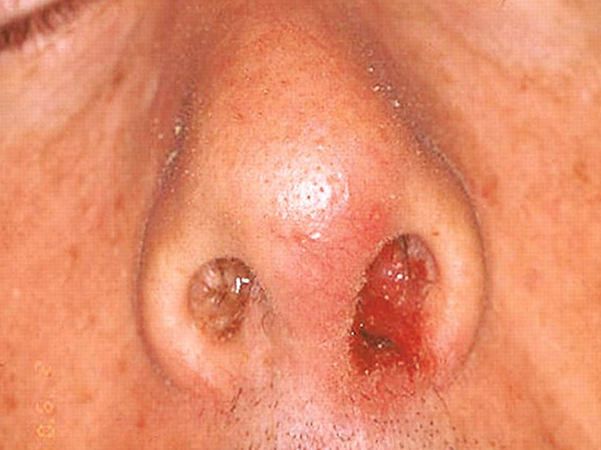 Симптомы в носу