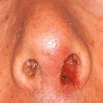 Стафилококк в носу: причины, симптомы и что делать