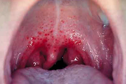 Симптомы в горле