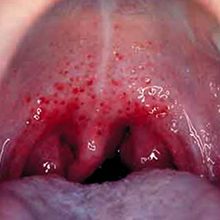 Стафилококк в горле: причины возникновения, симптомы и лечение