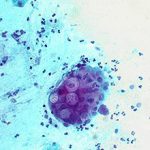 Chlamydia trachomatis у мужчин и женщин: симптомы и лечение