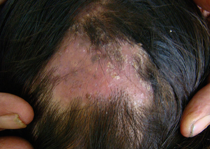 Демодекоз волосистой части головы