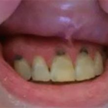 Черви в зубах — правда или вымысел?