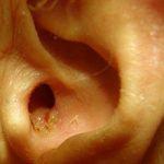 Стафилококк в ушах: симптомы и особенности лечения
